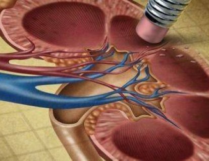 4. Evre Böbrek Kanseri İçin FDA, Lenvatinib Adlı İlacın Everolimus ile Birlikte Kullanımına Onay Verdi