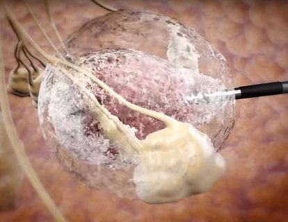 70 Yaş Üzeri Hastalar İçin Meme Kanserinde Kriyoablasyona FDA Pazarlama Yetkisi Verdi