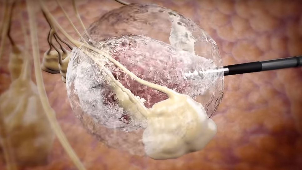 70 Yaş Üzeri Hastalar İçin Meme Kanserinde Kriyoablasyona FDA Pazarlama Yetkisi Verdi