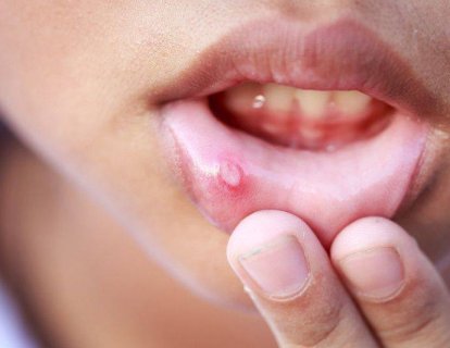 Kanser hastasında ağız yarası - oral mukozit