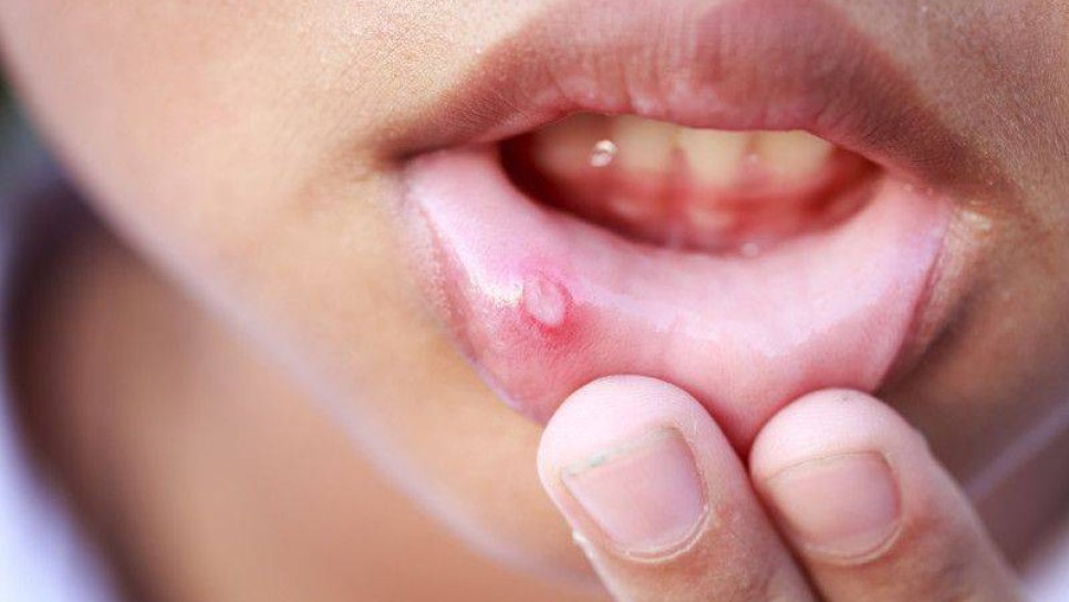 Kanser hastasında ağız yarası - oral mukozit