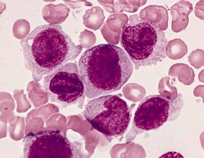 Akut Lenfoblastik Lösemi Tedavisinde Blinatumomab FDA Onayı Aldı