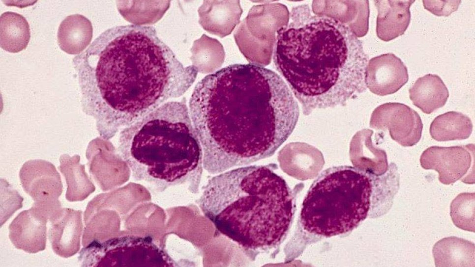 Akut Lenfoblastik Lösemi Tedavisinde Blinatumomab FDA Onayı Aldı