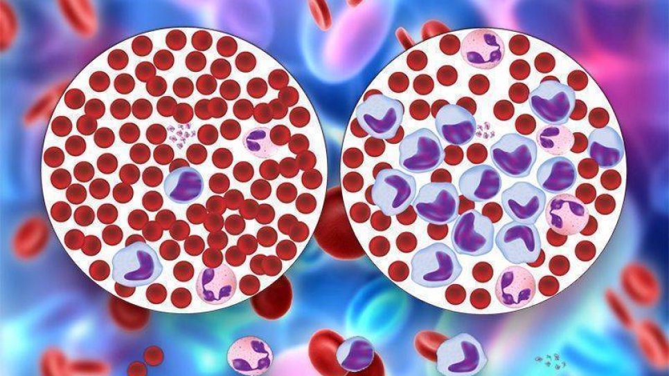 Akut miyeloid lösemi tedavisinde FDA onayı alan ilk akıllı ilaç: Midostaurin