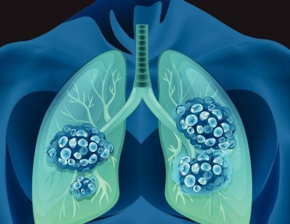 BRAF mutasyonu pozitif 4. evre akciğer kanseri tedavisi için yeni bir tedavi FDA onayı adı