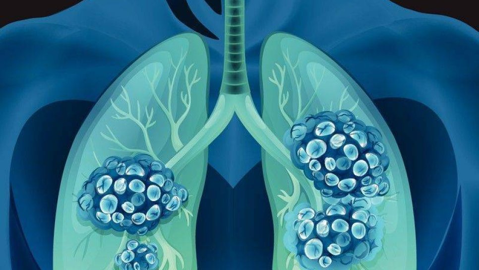BRAF mutasyonu pozitif 4. evre akciğer kanseri tedavisi için yeni bir tedavi FDA onayı adı