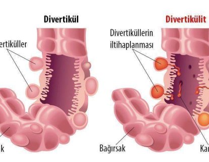 Divertikülit nedir? Kalın bağırsak kanserleriyle ilişkisi var mıdır?