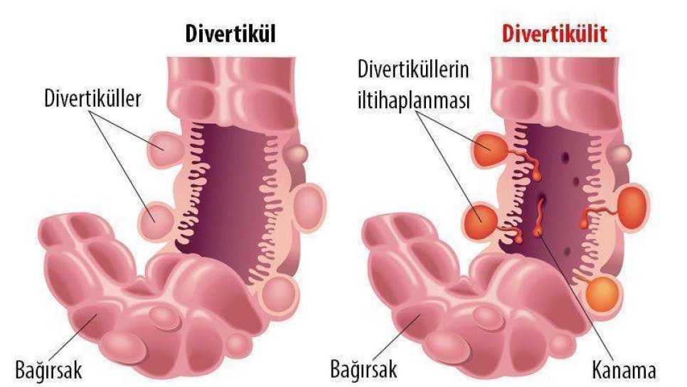Divertikülit nedir? Kalın bağırsak kanserleriyle ilişkisi var mıdır?