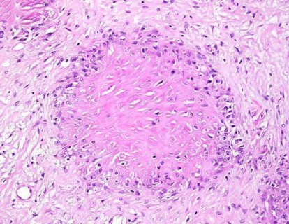 Düşük Dereceli Fibromiksoid Sarkom – Low Grade Fibromyxoid Sarcoma