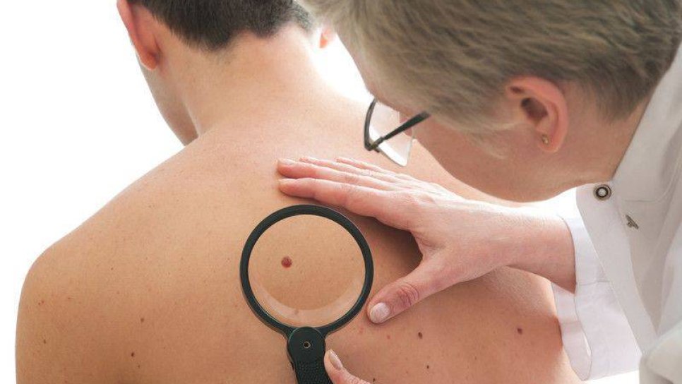 En Sık Görülen Kanser Türü Olan Cilt Kanseri Tedavisinde Yeni Bir İlaç, Yeni Bir Umut: Sonidegib (Odomzo)