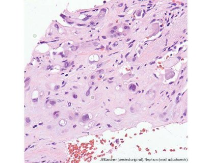 Epiteloid Hemanjioendotelyoma nedir? Belirtileri, tedavisi ve hastalık gidişatı