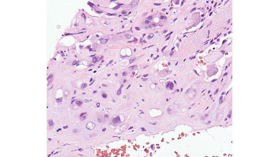 Epiteloid Hemanjioendotelyoma nedir? Belirtileri, tedavisi ve hastalık gidişatı