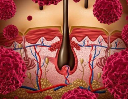 İleri Evre Melanomda Nivolumab ve İpilumumab’ın Birlikte Kullanımı Daha Avantajlı Olabilir Mi?