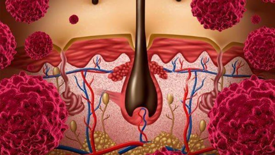 İleri Evre Melanomda Nivolumab ve İpilumumab’ın Birlikte Kullanımı Daha Avantajlı Olabilir Mi?