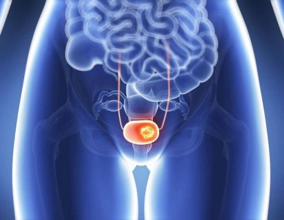 İmmünoterapi ilacı Atezolizumab, mesane kanseri tedavisi için FDA onayı aldı