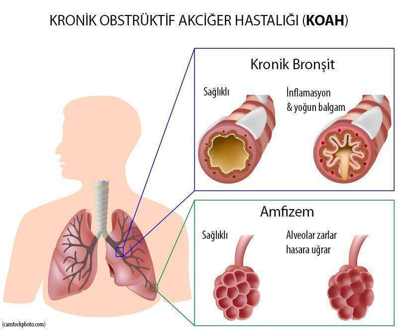 KOAH kronik obstruktif tikayici akciger hastaligi 1 237586
