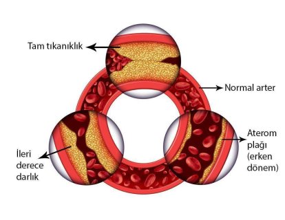 Kalp damar hastalığı nedir? Risk faktörleri nelerdir? Nasıl önlenir?