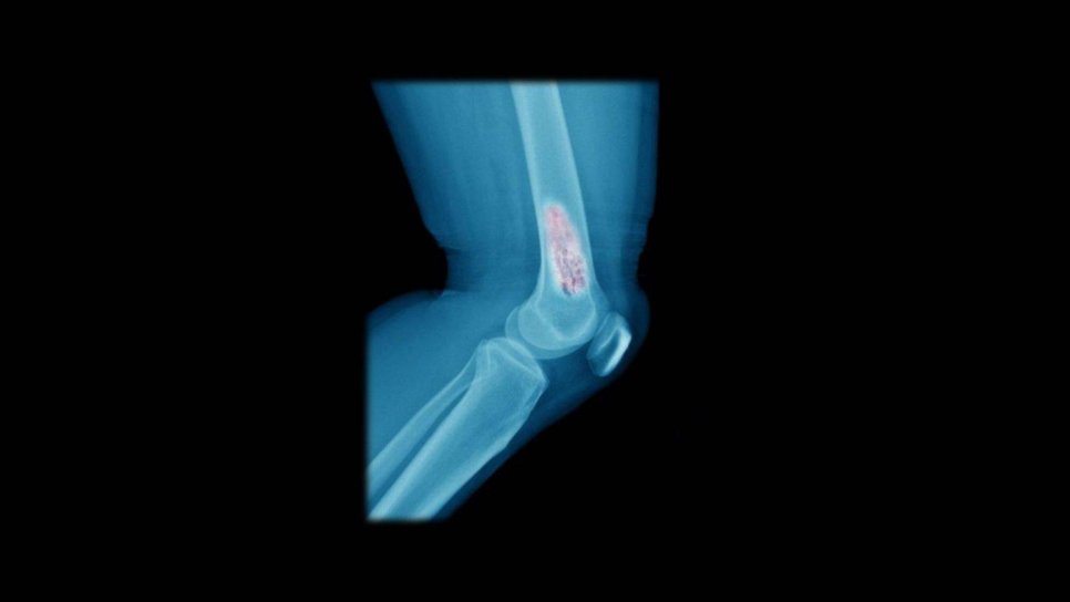 Kanser Türlerine Göre Tanı ve Tedavi Bölümünde Osteosarkom (Kemik Kanseri) Bölümü Güncellendi