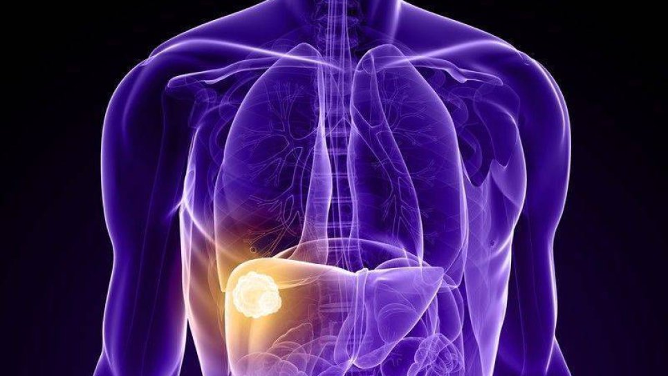 Karaciğer kanseri tedavisi için regorafenib (Stivarga) FDA onayı aldı