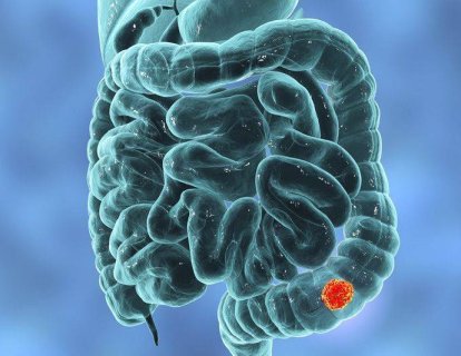 Kolon ve Rektum Kanseri Hakkında Bilinmesi Gerekenler