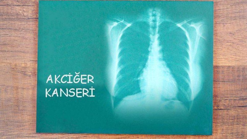 Küçük Hücreli Akciğer Kanseri Tedavisinde Uzun Yıllar Sonra Etkili Gözüken Bir İlaç Lurbinectedin