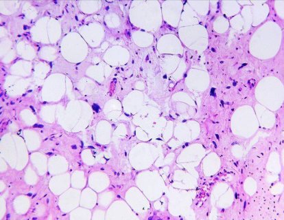 Liposarkom Tanılı hHastalarda Yeni Bir İlaç, Yaşam Sürelerini Uzattığı İçin Amerikan Gıda ve İlaç Dairesi (FDA) Onayı Aldı