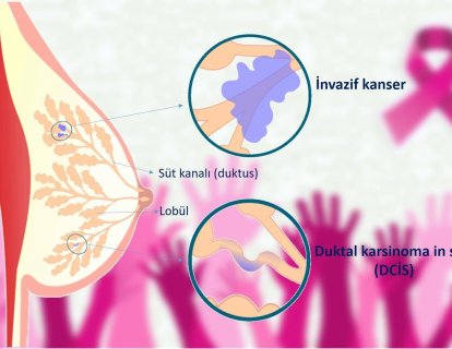 Meme kanseri çeşitleri nelerdir?