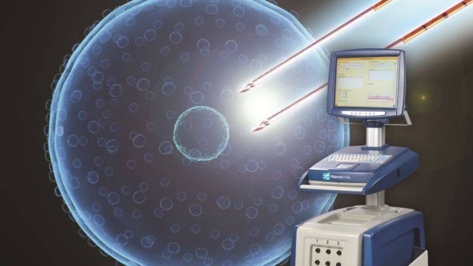 Metastatik olmayan, ameliyat edilemez (bölgesel ilerlemiş) pankreas kanserinde kombine tedavi yöntemi: kemoterapi, radyoterapi, cerrahi ve Nanoknife