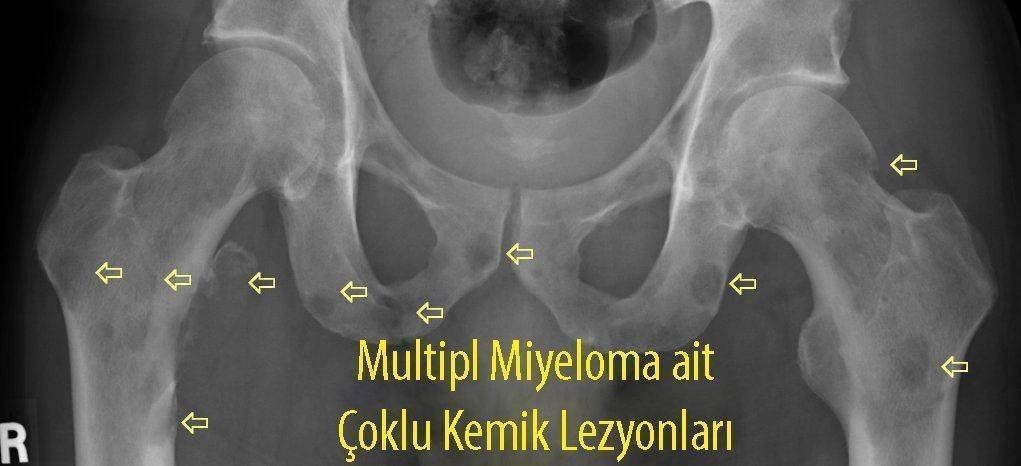 Multipl Miyelom tanisi nasil konulur 374786