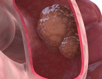 Oktreotid adlı ilaç metastatik nöroendokrin ince barsak tümörlerinin tedavisinde umut vadediyor