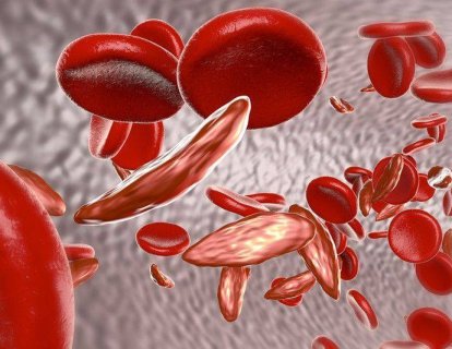 Orak Hücreli Anemi Ağrılı Kriz Tedavisi İçin L-Glutamin FDA Onayı Aldı