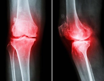 Osteoartrit, Eklem Kireçlenmesi Neden Kadınlarda Erkeklerde Daha Fazla?