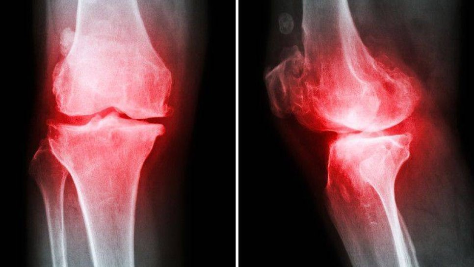 Osteoartrit, Eklem Kireçlenmesi Neden Kadınlarda Erkeklerde Daha Fazla?