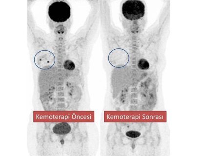 PET-CT meme kanserinde iyi gidişatı erken dönemde öngörüyor