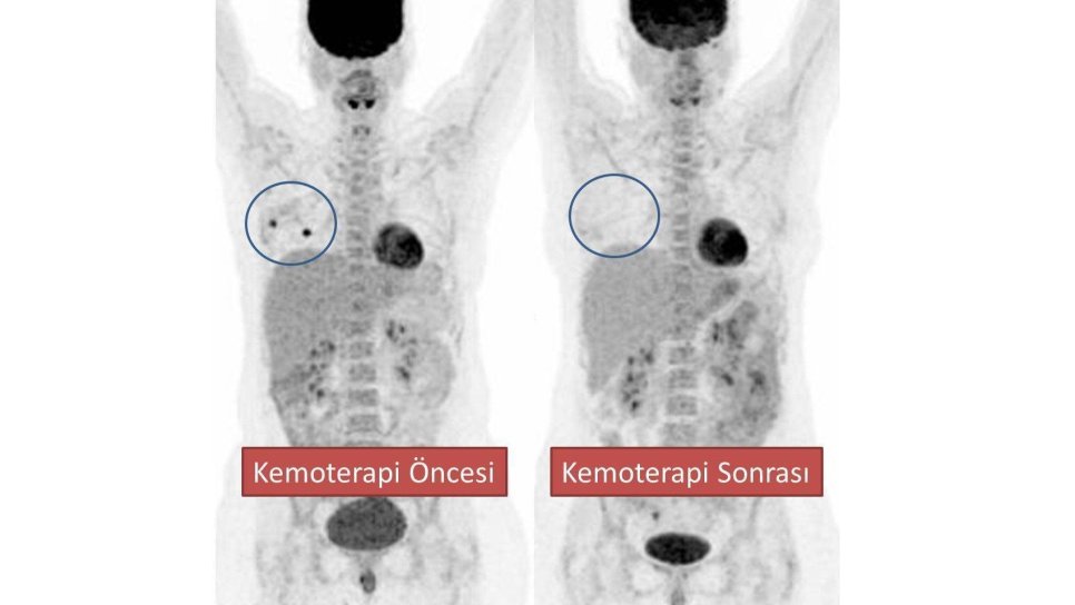 PET-CT meme kanserinde iyi gidişatı erken dönemde öngörüyor