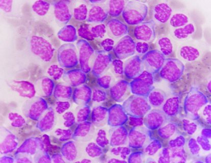 Pediatrik Kronik Miyeloid Lösemi Kronik Faz Tedavisinde Dasatinib FDA Onayı Aldı