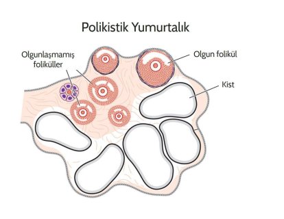 Polikistik Over Sendromu nedir, nasıl tedavi edilir?