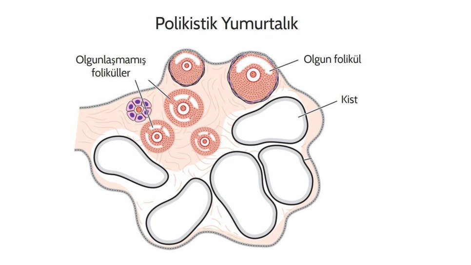 Polikistik Over Sendromu nedir, nasıl tedavi edilir?