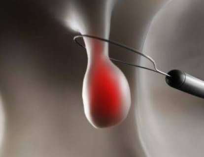 Polip nedir, kalın bağırsak polipleri nasıl tedavi edilmelidir?