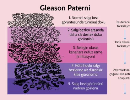 Prostat Kanserinde Doğru Tedavi İçin Bu Alanda Uzman Patologlardan İkinci Görüş Alınmalı Mıdır?