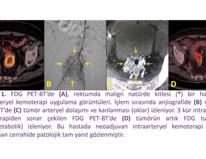 Rektum Kanserinde İntraarteryel Kemoterapi Sonuçlarımız