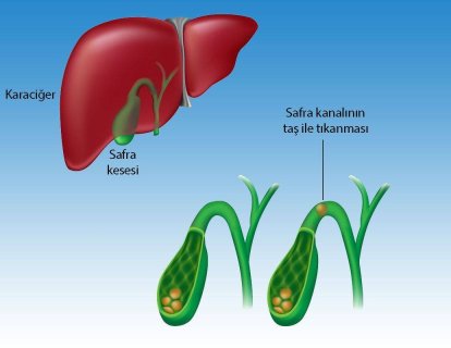 Safra kanalı taşı hastalığı koledokolitiazis belirtileri ve tedavisi