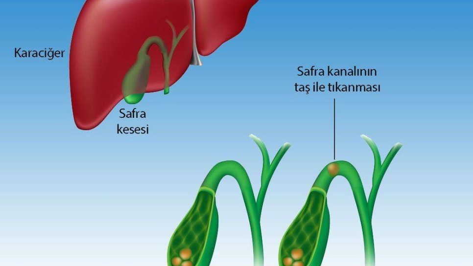 Safra kanalı taşı hastalığı koledokolitiazis belirtileri ve tedavisi
