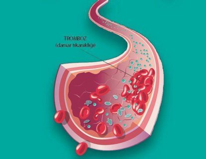 Toplardamar Tıkanıklığı - Venöz Tromboemboli İçin Yeni Bir Kan Sulandırıcı FDA Onayı Aldı