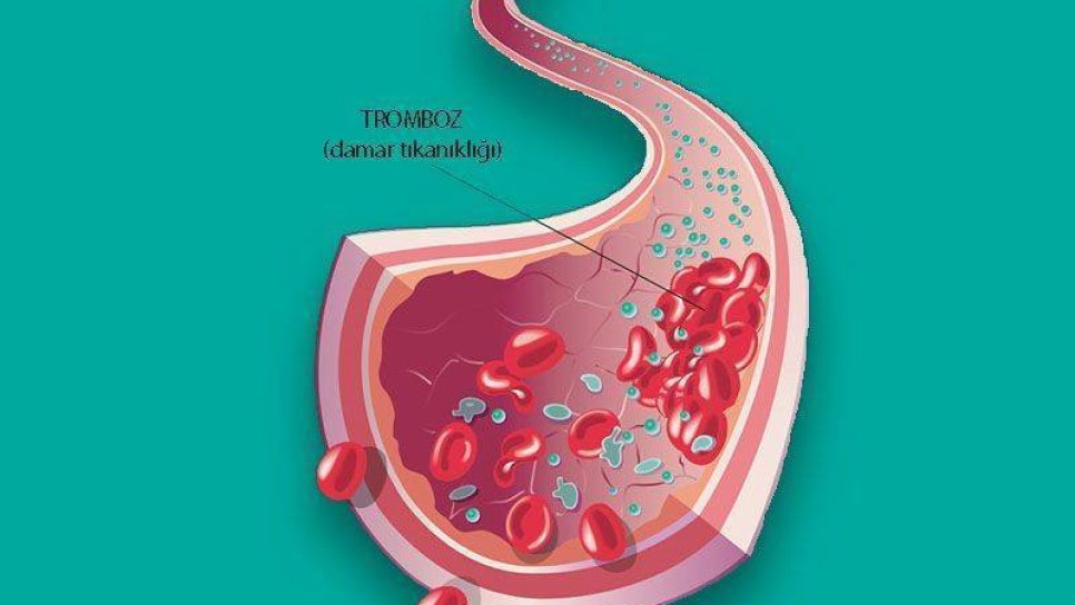 Toplardamar Tıkanıklığı - Venöz Tromboemboli İçin Yeni Bir Kan Sulandırıcı FDA Onayı Aldı
