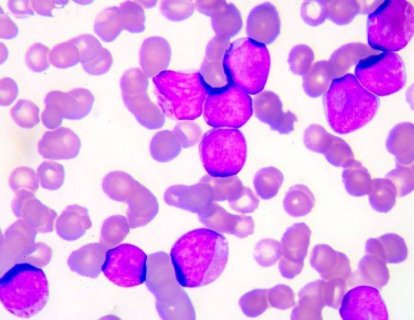 Yeni Tanı Almış Kronik Miyeloid Lösemi Tedavisinde Bosutinib Hızlandırılmış FDA Onayı Aldı