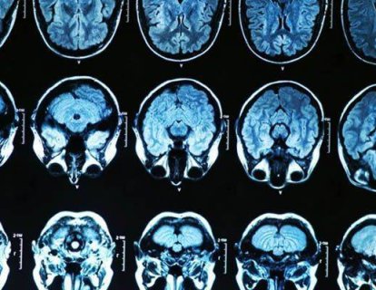 Yeni Teşhis Edilmiş Glioblastomda Bevasizumab Radyoterapi ve Temozolomid ile Birlikte Verildiğinde Etkili Olur Mu?