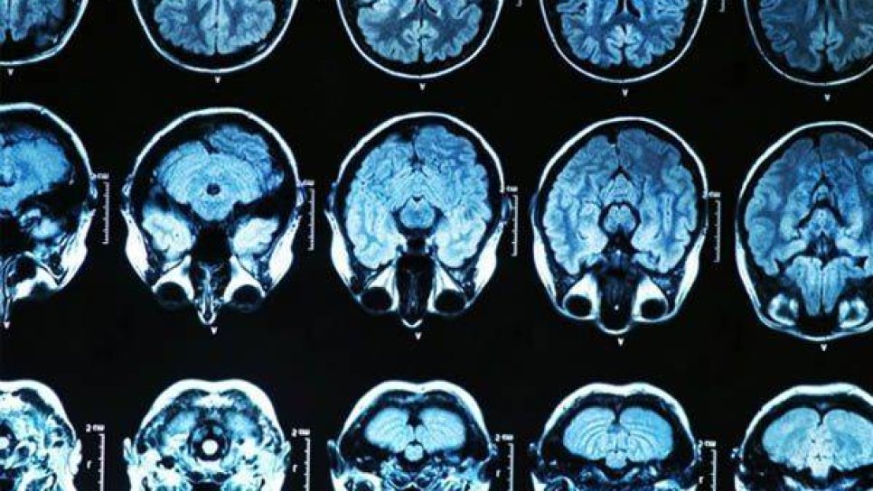Yeni Teşhis Edilmiş Glioblastomda Bevasizumab Radyoterapi ve Temozolomid ile Birlikte Verildiğinde Etkili Olur Mu?