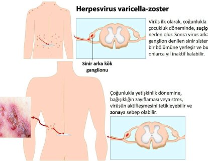 Zona Hastalığı Nedir? Belirtileri Nelerdir? Yeni Bir Aşı ile Zonadan Korunmak Artık Mümkün
