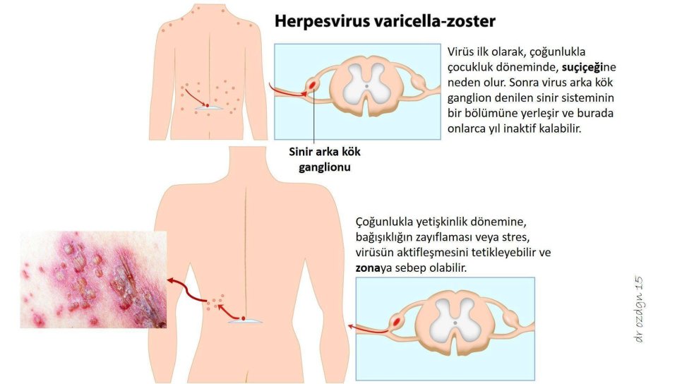 Zona Hastalığı Nedir? Belirtileri Nelerdir? Yeni Bir Aşı ile Zonadan Korunmak Artık Mümkün
